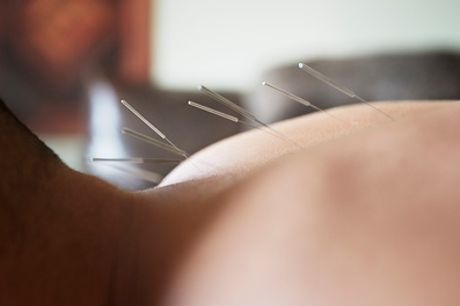 30-Minute Acupuncture and 30-Minute Reflexology Machine Session at Herbal Clinic