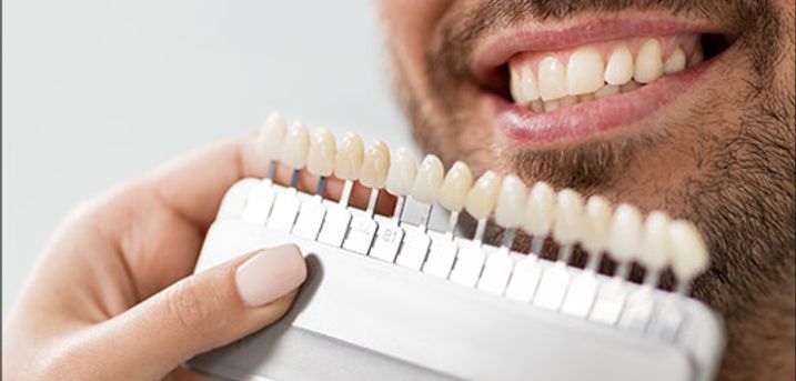  Få det flotteste hvide smil - Du får det flotteste tandpastasmil med en tandblegning i klinikken eller hjemmeblegning, værdi op til kr. 2600,- 