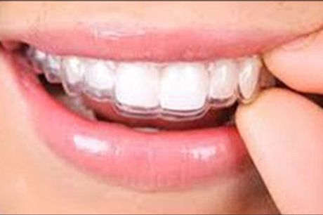  Vejen til et flot tandsæt - Få en startpakke til flotte tænder med Clear Aligner. Værdi kr. 3250,- 